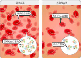 贫血是因为身体血液量少吗