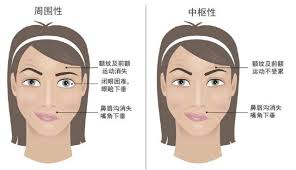 哪种降温方式会引发面瘫