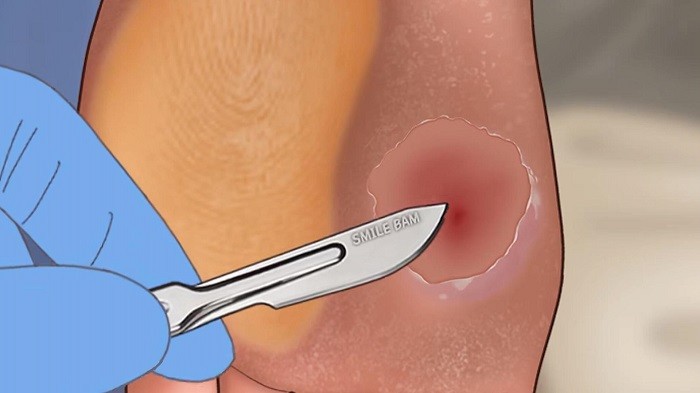 修脚足疔模拟器去更新版